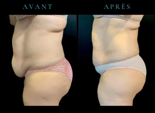 Photo avant/après d'une séance de Cryolipolyse : réduction des amas graisseux